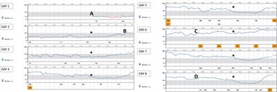 Alpelisib-Induced Diabetes Mellitus: Case Report, Pharmacodynamics and Management Considerations